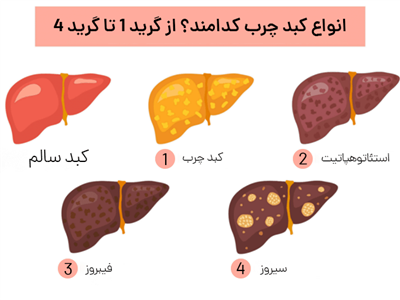 ۴ گرید کبد چرب را بیشتر بشناسیم