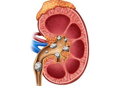 درمان­‌های تغذیه­‌ای سنگ‌ کلیه