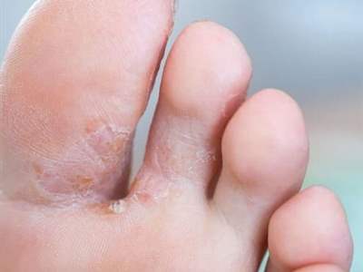 پا در هر کفشی نکنید/ عفونت های قارچی پا و روش درمان آنها
