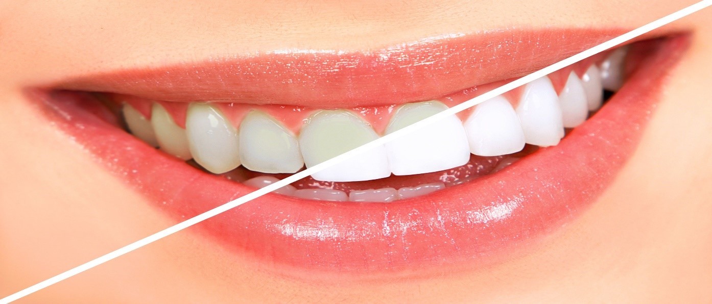 بهترین روش سفید کردن دندان