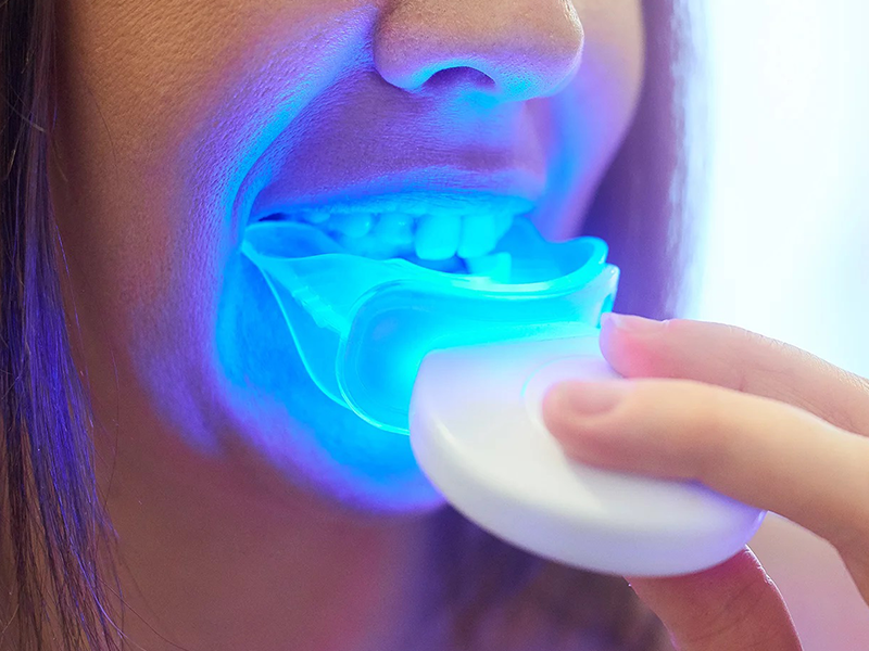 روش سفید کردن دندان ها
