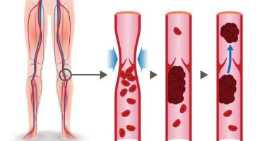 چگونه متوجه لخته خون در بدن شویم