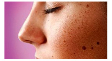  ۷ عاملی که باعث بروز لکه‌های تیره روی پوست می‌شود