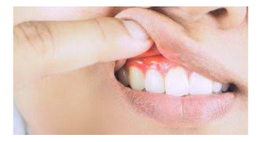 درمان زخم دهان دارو دارد؟ 