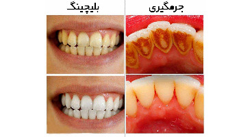 اطلاعات کامل در مورد  سفیدکردن دندان؛ از بلیچینگ تا لمینت