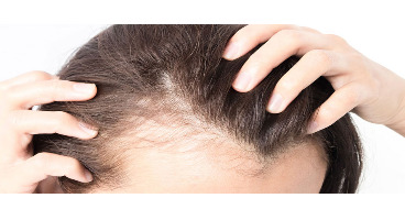 افزایش تراکم مو با چند روش خانگی 