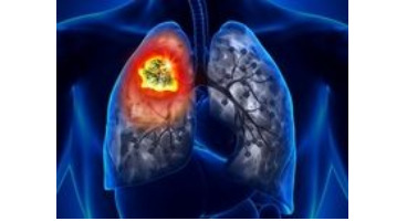 ۴ نشانه عجیب سرطان ریه که باید از آنها آگاه باشید 