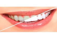 معرفی بهترین روش های سفید کردن دندان ها